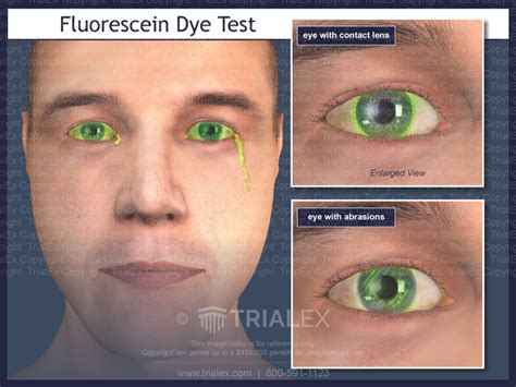 shirmer tear test and fluorescein stain and tonometery|fluorescein ophthalmic test.